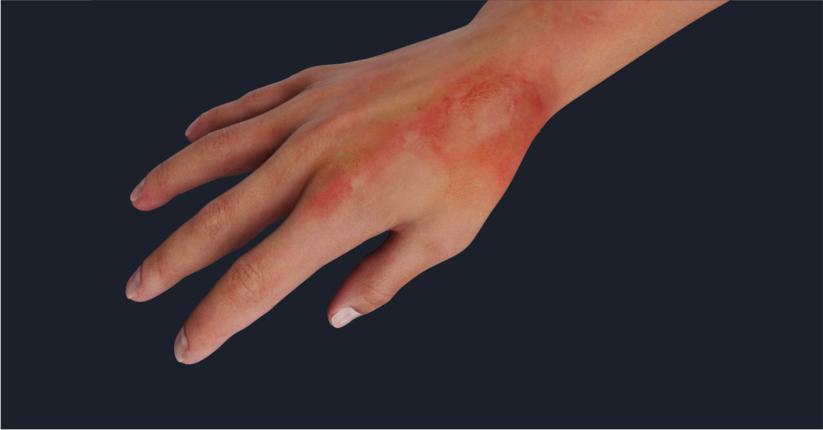 Burn Injuries – NBKomputer