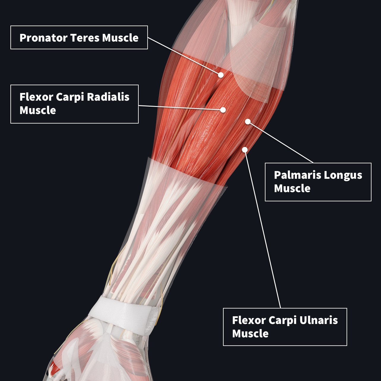 The anterior compartment of the forearm showing the superficial muscles including the Pronator Teres, Palmaris Longus, Flexor Carpi Radialis and the  Flexor Carpi Ulnaris