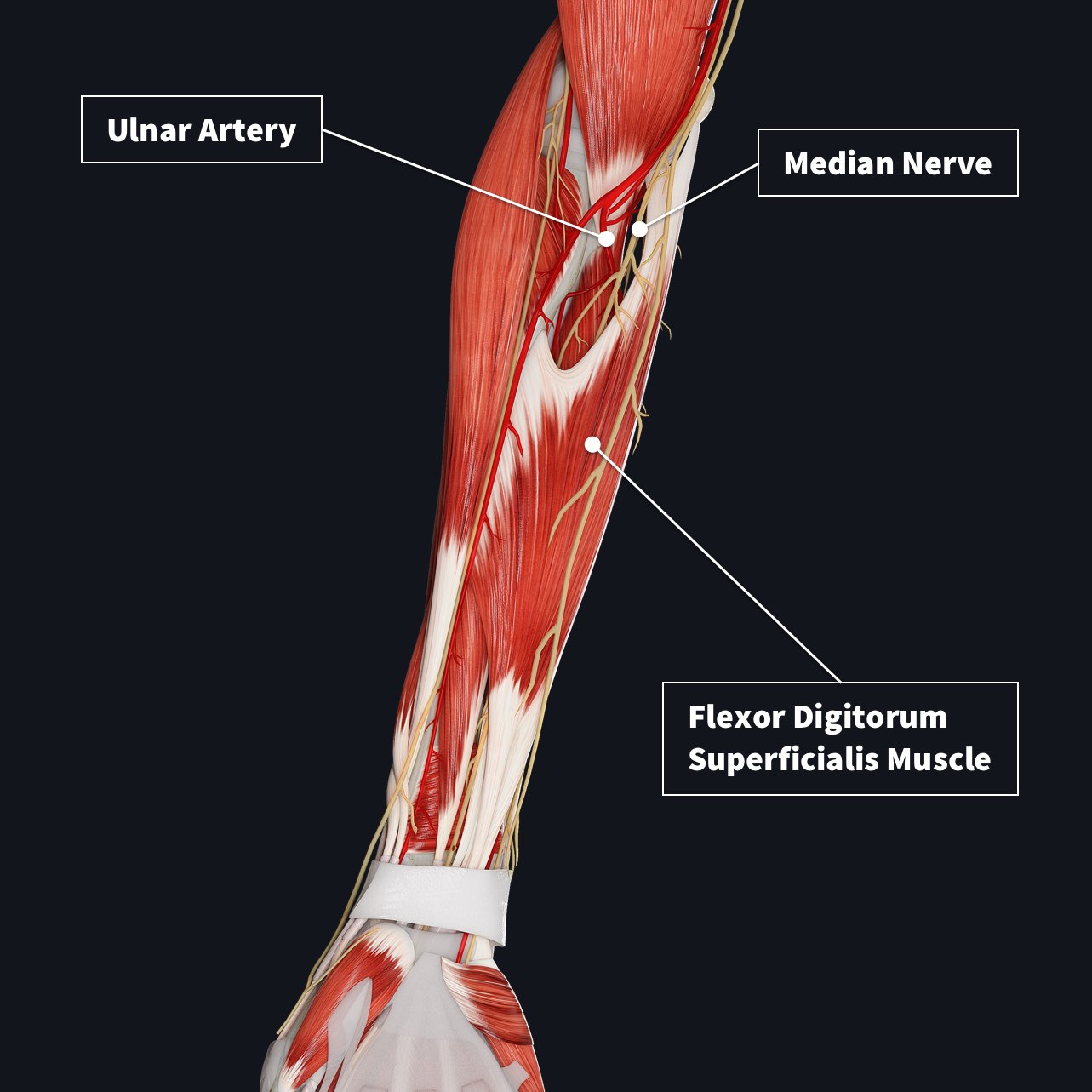 The anterior compartment of the forearm showing the Flexor Digitorum Superficialis Muscle of the intermediate group