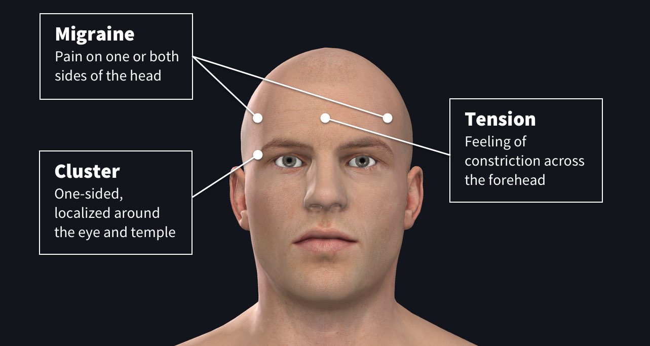 the-facts-about-headaches-complete-anatomy