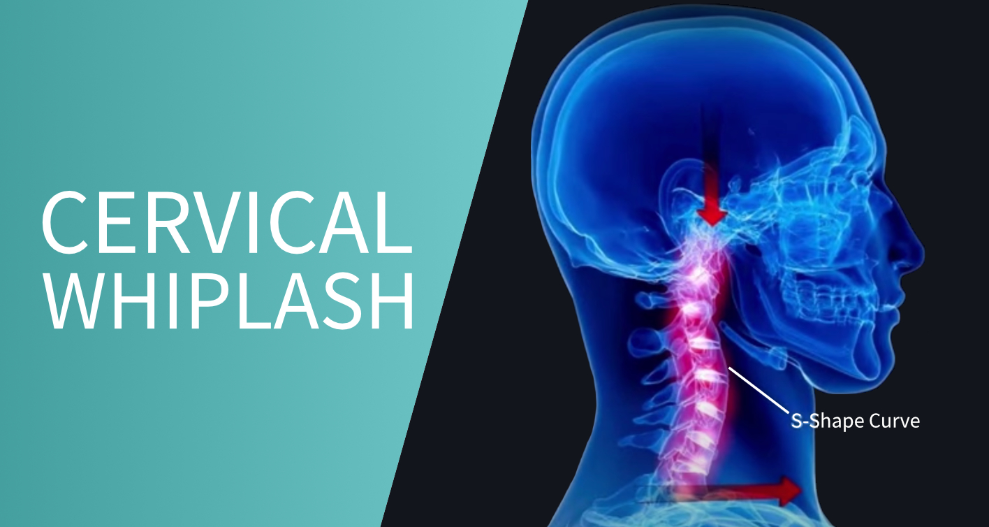 Understanding “Whiplash”