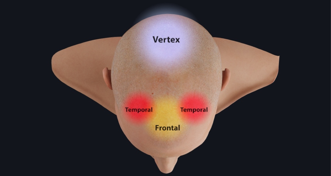 The facts on pattern baldness