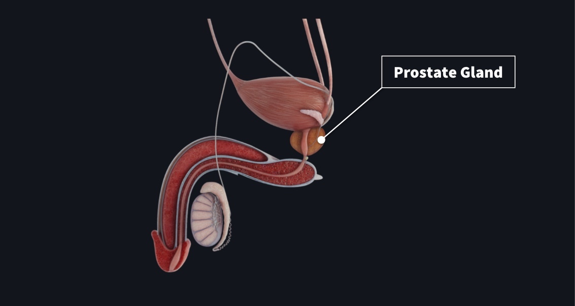 Prostate cancer: Early detection is key